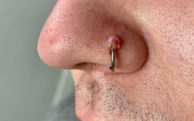 Piercing infectado